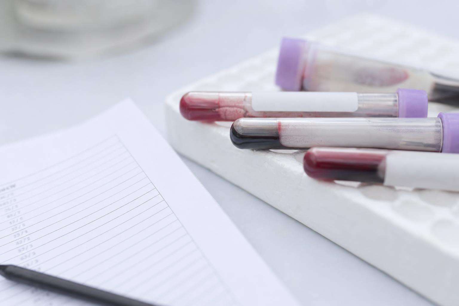 Blood test tubes and lipid panel printout concept on a clean desk, no people